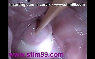 Insertion cock juice cum in cervix just about dilatation twat reflector